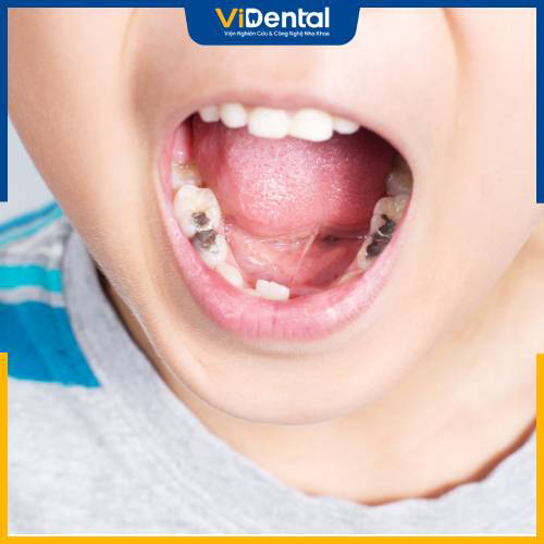 Sâu răng ở trẻ 14 tuổi thường gây tổn thương răng vĩnh viễn