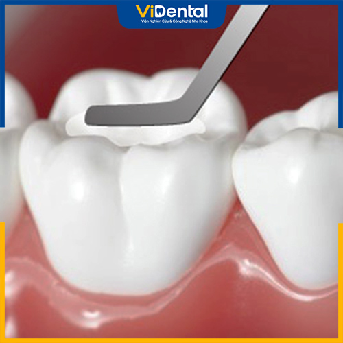 Trám răng là phương pháp áp dụng cho sâu răng nhẹ và trung bình
