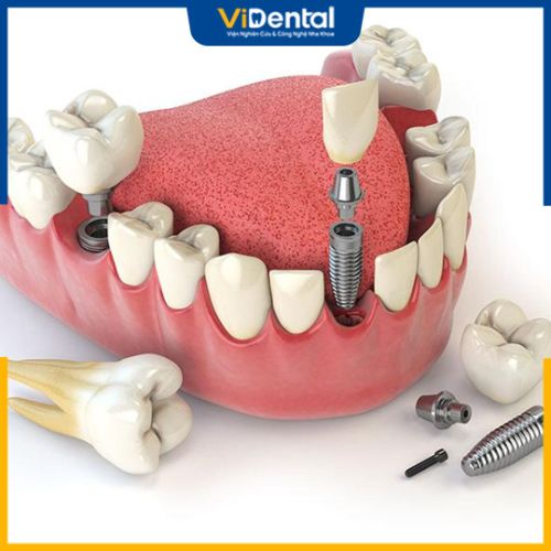 Xương hàm cần đảm bảo đạt chuẩn để trồng răng Implant