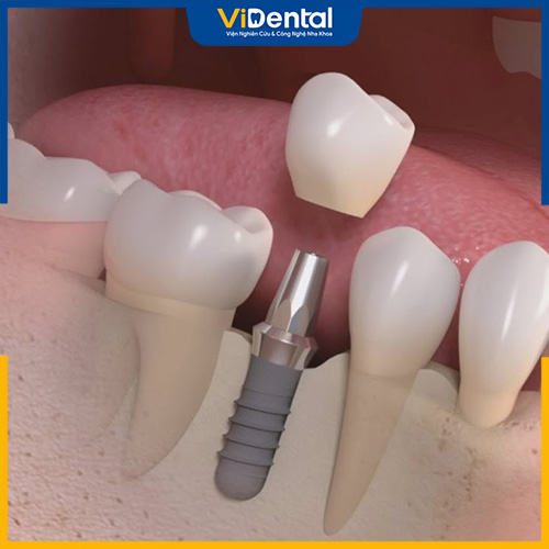 Răng implant bị lệch sẽ gây đau nhức và một số biến chứng khác