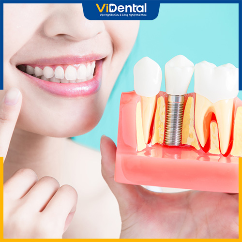 Cần chú ý phòng tránh các biến chứng khi trồng răng Implant