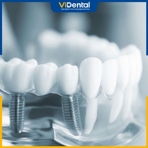 Trồng răng implant sẽ bị sưng mặt khoàng 4 - 7 ngày