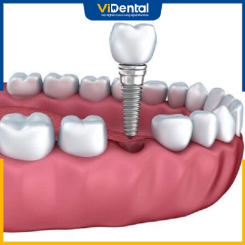 Phục hình răng sứ Implant sở hữu nhiều ưu điểm vượt trội
