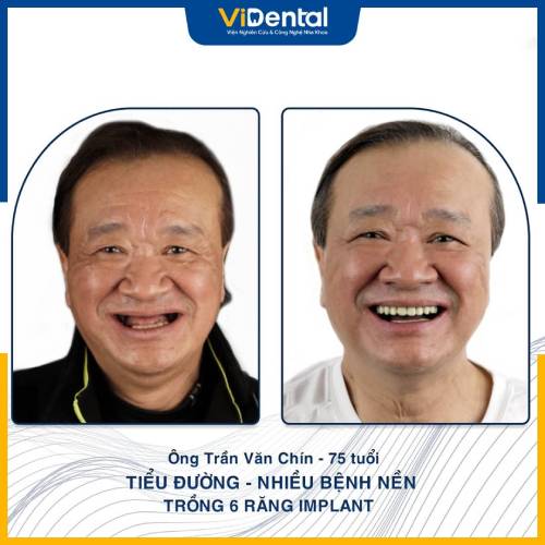 Hình ảnh bệnh nhân cao tuổi sau khi phục hình răng tại ViDental Implant 