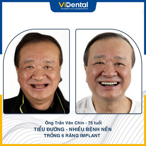 Nhiều bệnh nhân cao tuổi đã trồng răng thành công tại Trung Tâm ViDental Implant