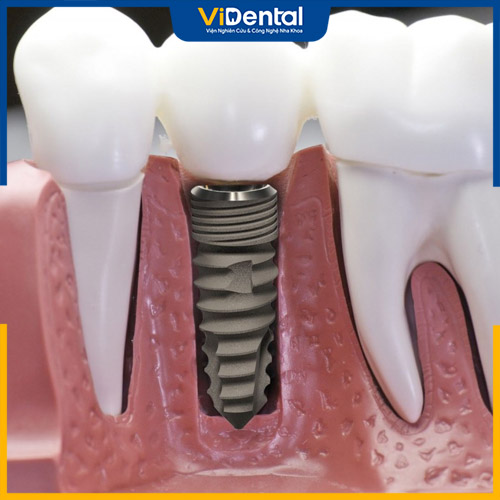 Trồng răng Implant cho người cao tuổi hết từ 5.000.000 VND