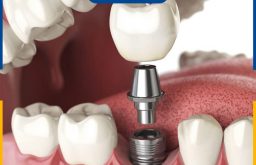 Giá Trồng Răng Implant TPHCM Bao Nhiêu? Làm Ở Đâu Giá Tốt?