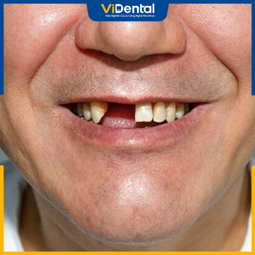 Có nhiều nguyên nhân có thể dẫn đến việc bị mất 3 răng cửa