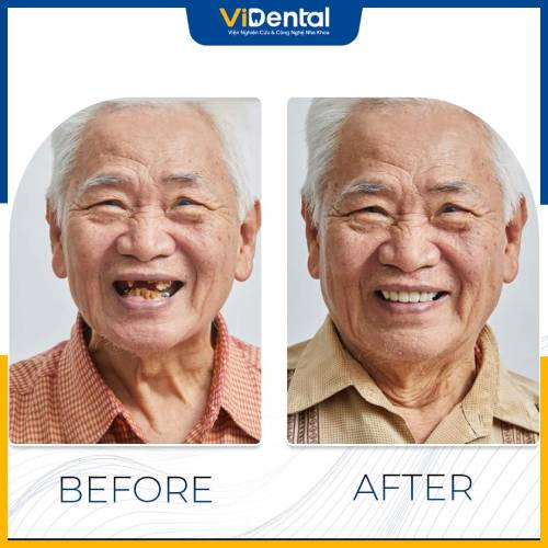 Khách hàng hài lòng với kết quả phục hình 3 răng cửa bị mất tại ViDental