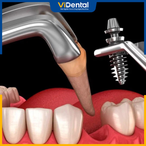 Trồng Implant tức thì sau khi nhổ răng là kỹ thuật mới