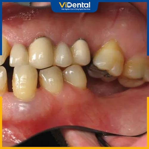 Các bệnh lý về răng miệng có thể dẫn đến mất răng