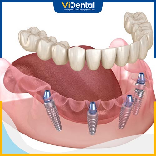 Khắc phục tình trạng mất răng toàn hàm bằng kỹ thuật trồng implant All on 4