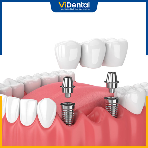 Theo các chuyên gia, nên trồng răng bằng phương pháp cấy ghép Implant