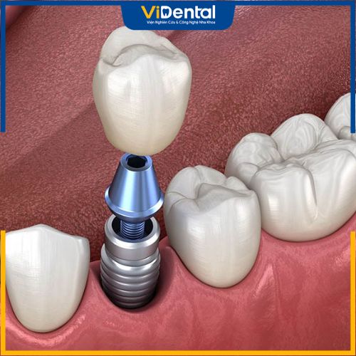 Trồng răng Implant là phương pháp phục hình răng mất được nhiều người chọn