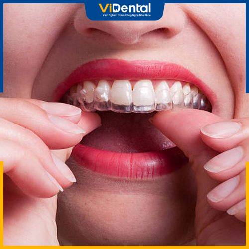 Thời gian niềng Invisalign nhanh hay chậm sẽ phụ thuộc vào độ phức tạp của hàm răng