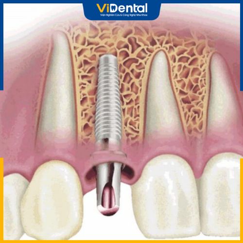 Dấu hiệu cho thấy răng implant bị đào thải