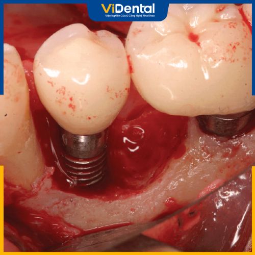 Răng implant đào thải có thể bị sưng đau, chảy máu