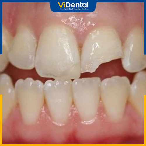 Trường hợp răng vỡ mẻ nhẹ có thể trám răng hoặc dán sứ veneer phục hình