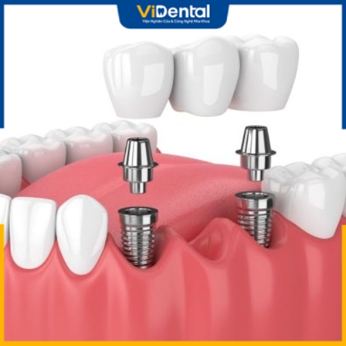 Tháo trụ răng Implant đòi hỏi cao tay nghề của bác sĩ