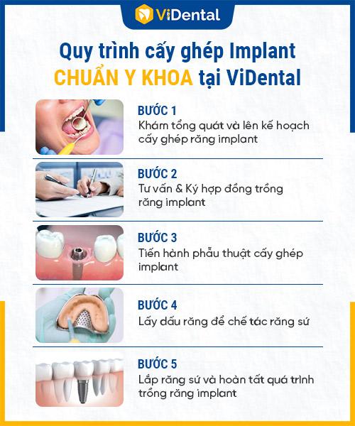 Quy trình trồng răng Implant 5 bước - 3 chuẩn tại ViDental