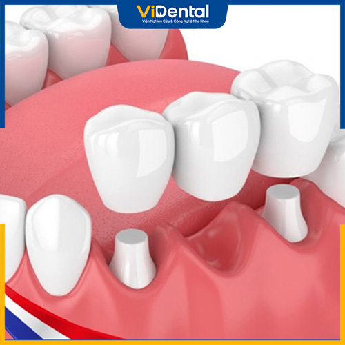 Làm cầu răng sứ giúp phục hồi nhiều răng bị mất, hỏng