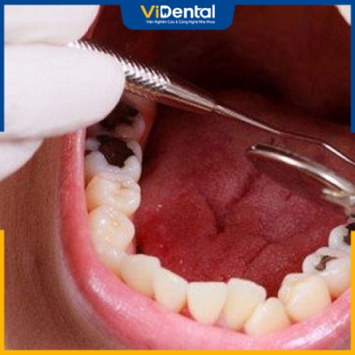 Lấy tủy răng, bọc sứ trước khi trồng răng giúp đảm bảo sức khỏe răng miệng