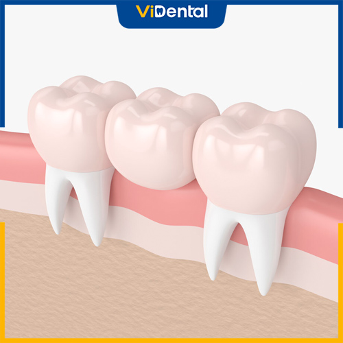 Trồng răng sứ bắc cầu giúp phục hình răng cửa nhanh chóng hiệu quả
