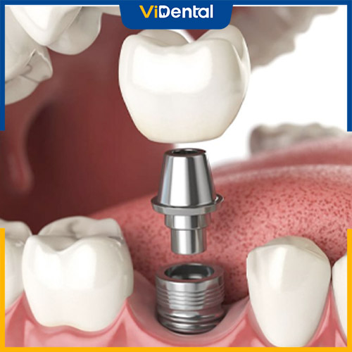 Trồng răng Implant là phương pháp trồng răng cửa bị gãy tối ưu nhất