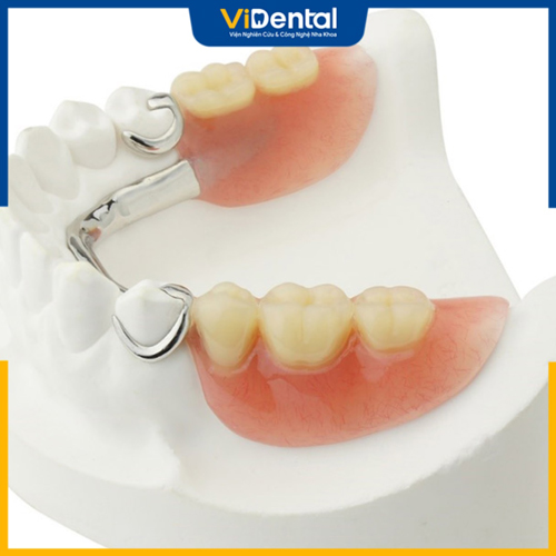 Trồng răng giả tháo lắp có mức chi phí rẻ nhất hiện nay