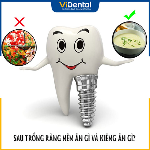 Cần chú ý nên và không nên ăn gì sau khi cấy trụ, trồng răng Implant