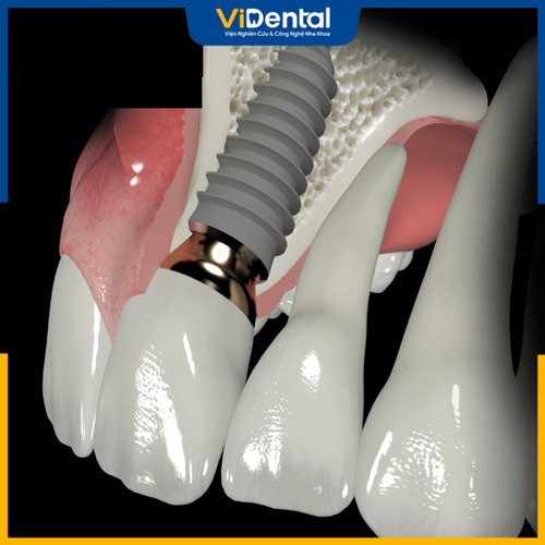 Trồng răng Implant - Giải pháp tối ưu để phục hình răng hàm trên bị mất