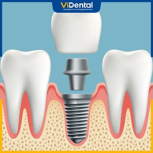 Cần cẩn trọng khi chọn nha khoa trồng răng Implant tại TPHCM