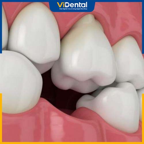 Tiêu xương hàm hay còn có tên gọi là tiêu xương răng