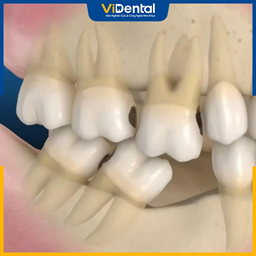 Nhiều người thắc mắc không biết khi mất răng bao lâu thì tiêu xương hàm