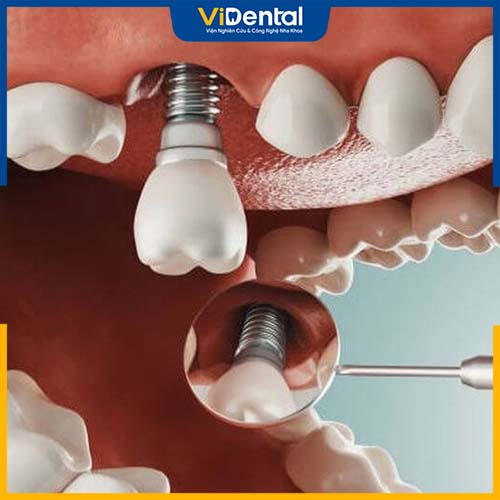Gắn trụ implant là phương pháp trồng răng khi bị tiêu xương hàm hiệu quả