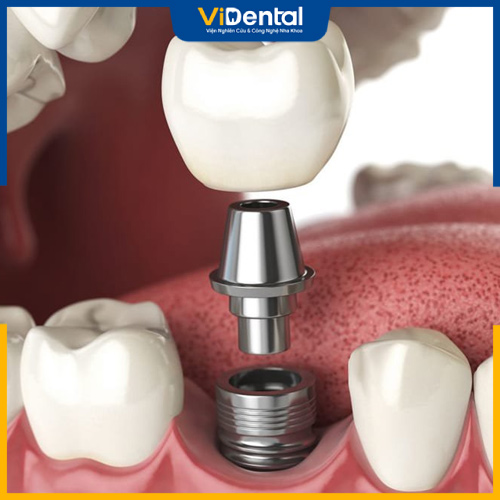 Cấy ghép và trồng răng Implant giúp phục hình tối ưu