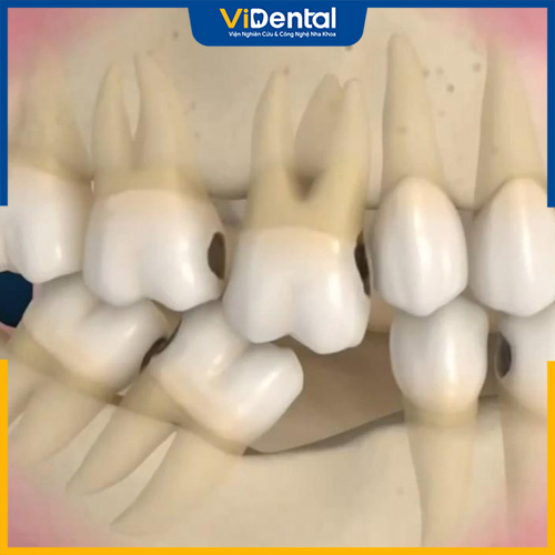 Trồng răng sứ không chân răng giúp hạn chế các biến chứng do mất răng
