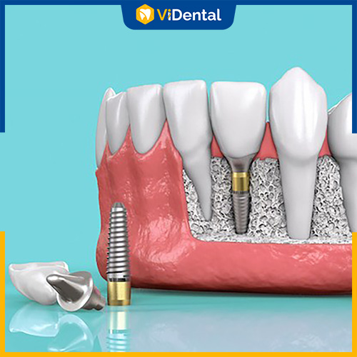 ViDental Implant là đơn vị trồng răng sứ uy tín, tin cậy