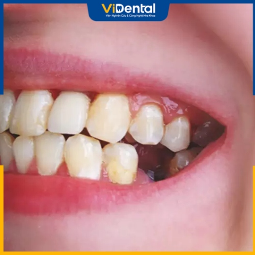 Tình trạng mất răng là nỗi lo lắng của nhiều khách hàng