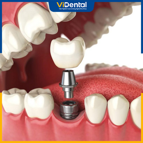 Trồng lại răng số 6 trên trụ Implant được nhiều người lựa chọn