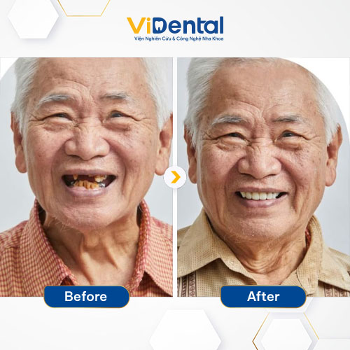Hình ảnh trước và sau khi trồng răng Implant của bệnh nhân ViDental