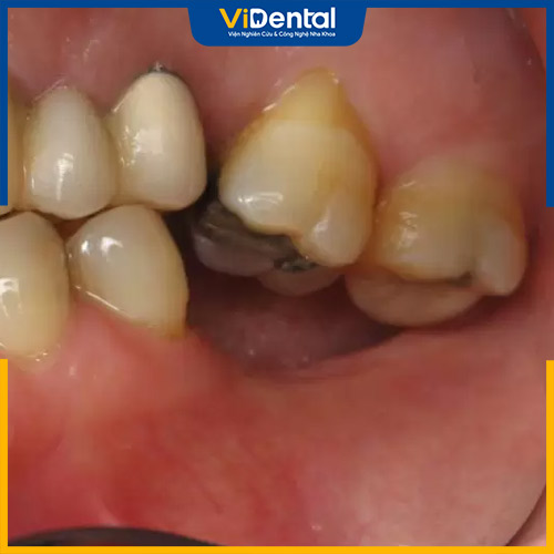 Mất 2 răng liền kề không khắc phục khiến các răng hàm trên bị tụt chân răng
