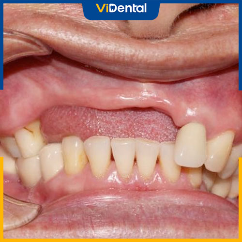 Mất 4 răng cửa gây ra nhiều hậu quả nghiêm trọng
