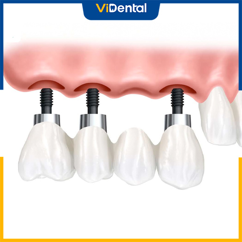 Trồng răng Implant là giải pháp tối ưu cho trường hợp bị mất răng cửa