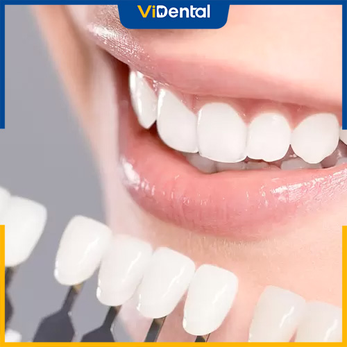 Có nhiều phương pháp phục hình răng cửa