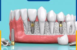 Vì sao răng implant bị lung lay