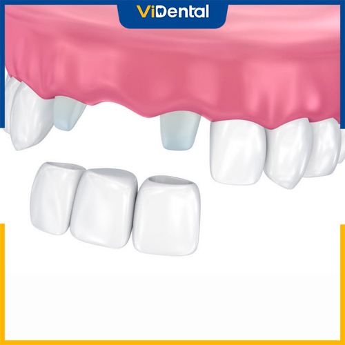 Bắc cầu sứ giúp phục hình răng tốt, đảm bảo chức năng ăn nhai và thẩm mỹ, nhưng không ngừa được tiêu xương