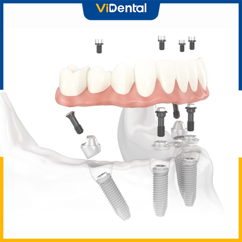 Cấy ghép Implant là giải pháp tối ưu nhất cho trường hợp mất 4 răng cửa