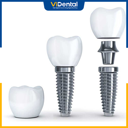 Chất lượng trụ Implant quyết định sự thành công của trồng răng