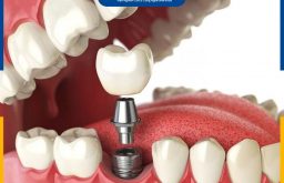 11 Địa Chỉ Trồng Răng Implant Tại Hà Nội Được Đánh Giá Cao